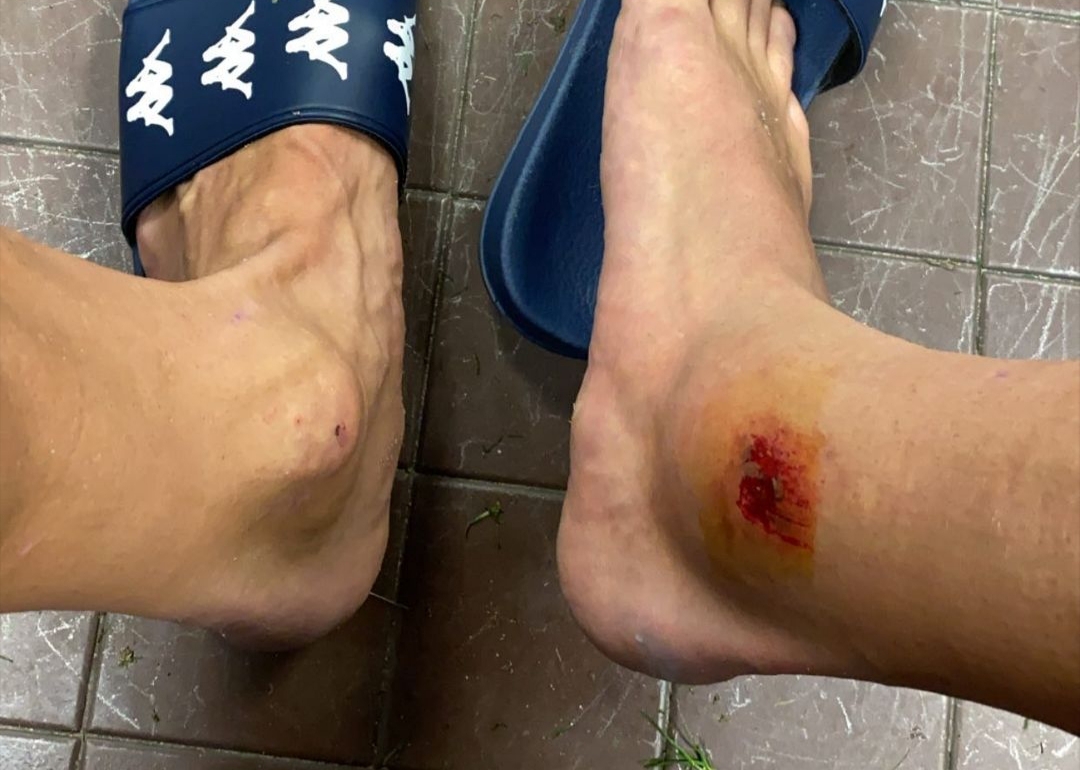 Lirola mostra come è ridotta la sua caviglia dopo la partita vinta contro l’Udinese